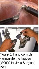 Figure 3: Hand controls manipulate the images (©2009 Intuitive Surgical, Inc.)